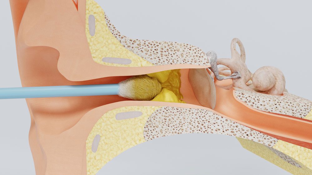 ear wax removal with cotton bud cross-section