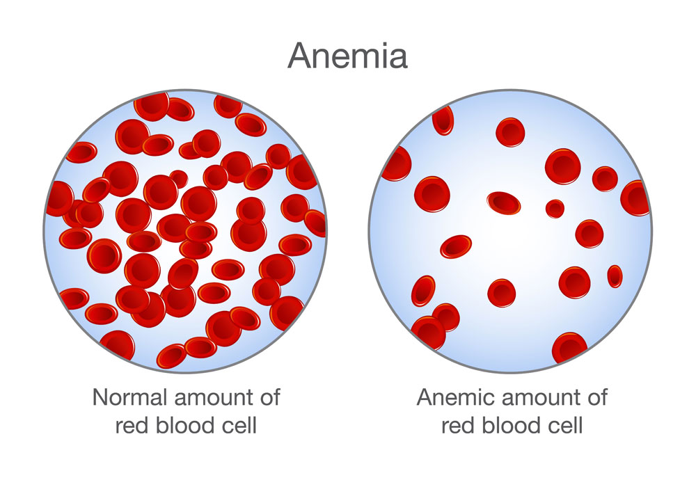 normal red blood cell and anaemia