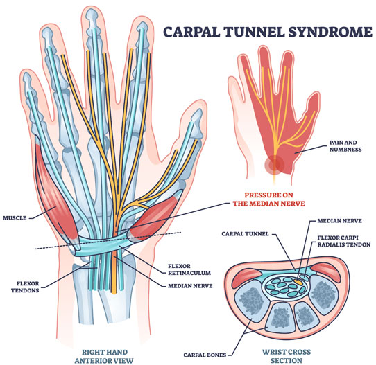workcover carpal tunnel syndrome