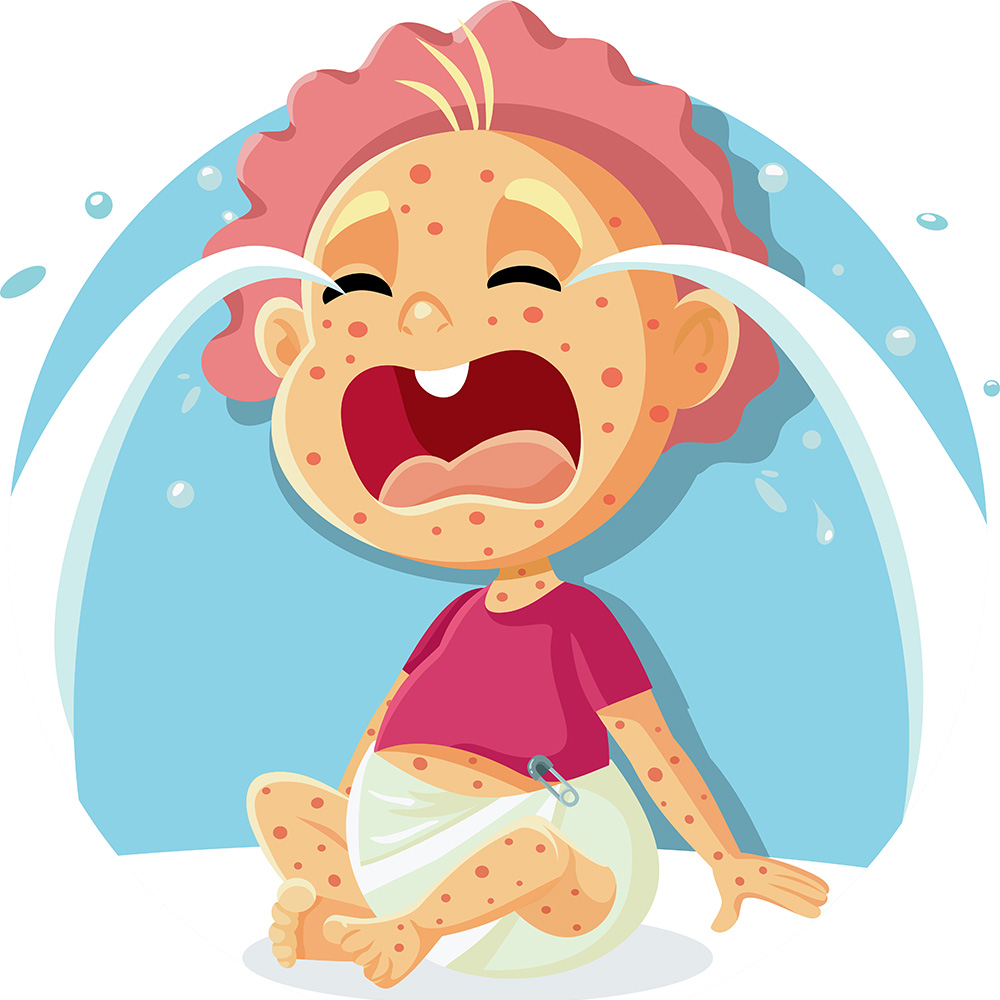 baby with chickenpox and shingles posibility
