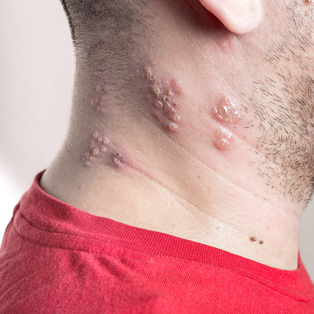 shingles on the neck and sides