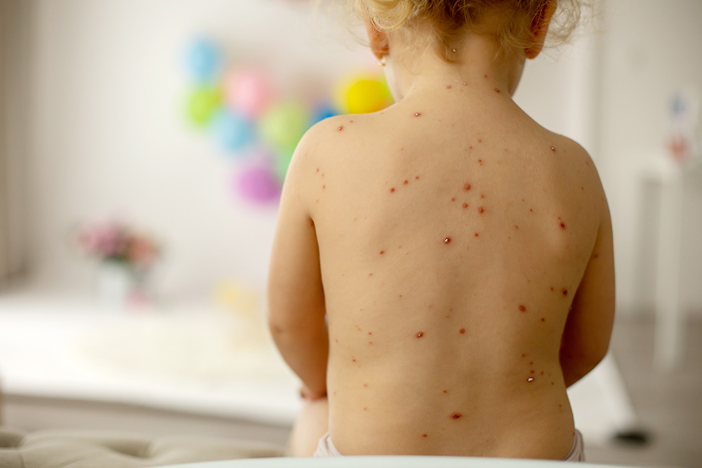 toddler with chickenpox