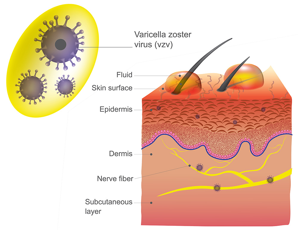 varicella zoster virus chickenpox and shingles